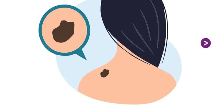 23 DE MAYO / DÍA MUNDIAL DEL MELANOMA:: Cuidá tu piel. Controlá tus lunares
